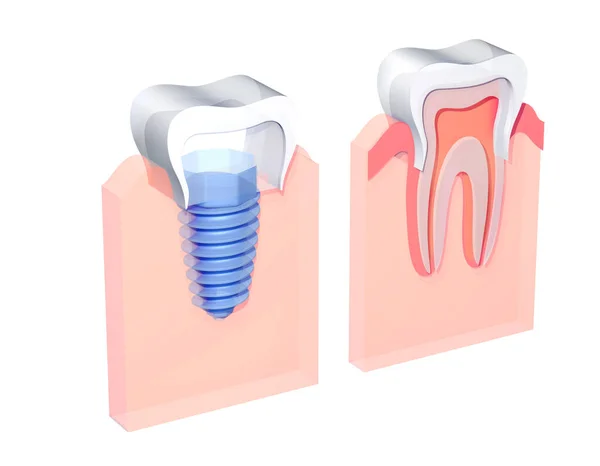 Illustrazione Impianto Dentale Una Gomma Accanto Dente Normale Stile Grafico — Foto Stock
