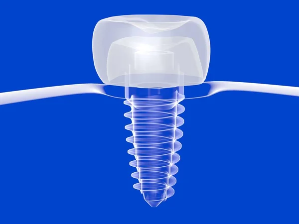 3d illustration of a dental implant in transparent graphic style. Put in glass gum on blue background.