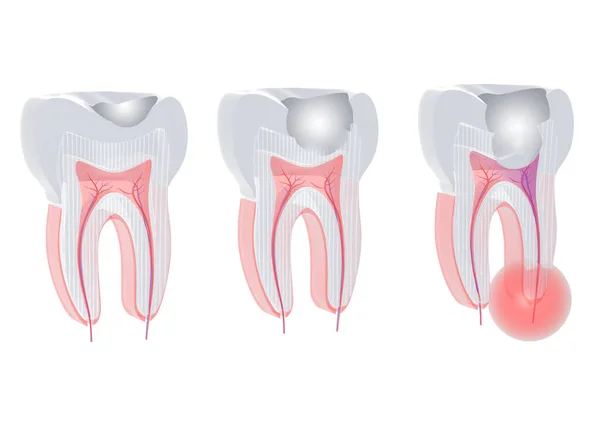 Caries işleminin üç aşamalı üç boyutlu illüstrasyonu. İçeriye bakan bir dişte ve enfeksiyonda görülüyor..