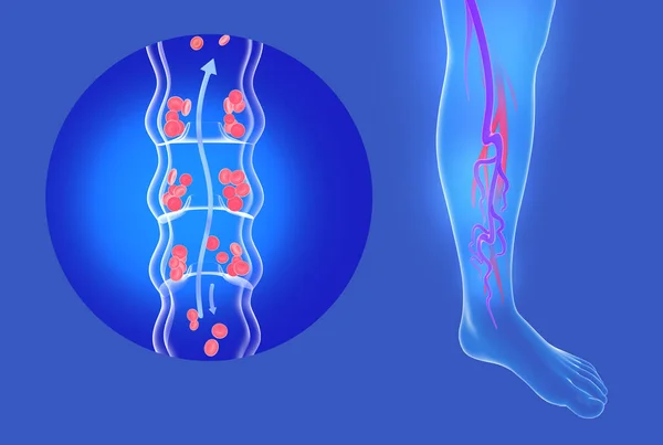 Anatomical 3d illustration of incompetent vein and varicose veins in legs. Transparent circulatory system of veins.