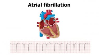 EKG kalp animasyonlu atriyal fibrilasyon aritmisi gösteriyor.