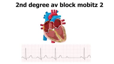 ecg kalp animasyonu ile 2d derece av bloğu Mobitz 2 gösterir