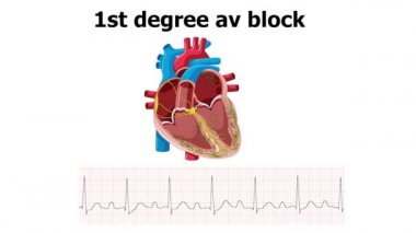 EKG kalp animasyonuyla birinci derece av bloğu gösteriyor