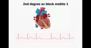 ecg kalp animasyonu ile 2d derece av blok Mobitz 1 gösterir