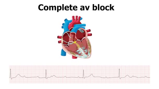 Ecgは心臓アニメーションの完全なAvブロック 3度のAvブロック を示しています — ストック動画