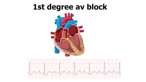 Ecg Muestra Bloqueo Primer Grado Con Animación Del Corazón — Vídeos de Stock