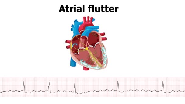 Ecg Montre Une Arythmie Flutter Auriculaire Avec Animation Cardiaque — Video