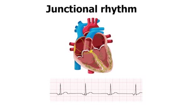 Ecg Montre Une Arythmie Rythme Conjonctionnel Avec Animation Cardiaque — Video