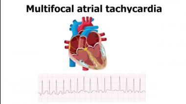 EKG, kalp animasyonuyla çok odaklı taşikardi (MAT) aritmisi gösteriyor