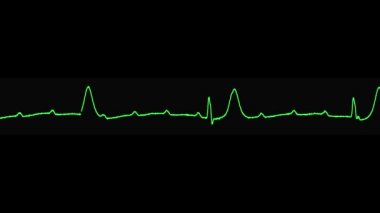 ecg kalbin tüm av blok (3. derece av blok) göstermektedir