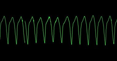 EKG kalbin ventriküler taşikardisini (VT) gösterir