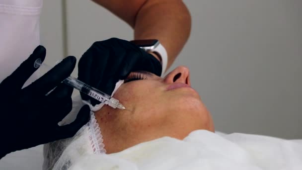 Facelifting mit Füllstoffen, Schönheitsinjektionen des Jochbeins. — Stockvideo