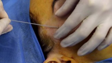 Spiral bir iplikle yüz kaldırma işlemi yenileniyor.