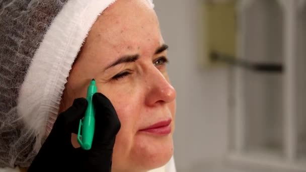 Marcando Paciente Com Marcador Antes Procedimento Injeção Beleza Facial Salão — Vídeo de Stock