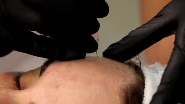 Zastrzyki kosmetyczne wykonuje się wstrzykując zmarszczki brwi na czole do tkanki. — Wideo stockowe
