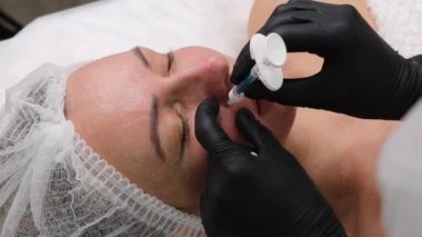 Filling the nasolabial fold for an adult woman with filler