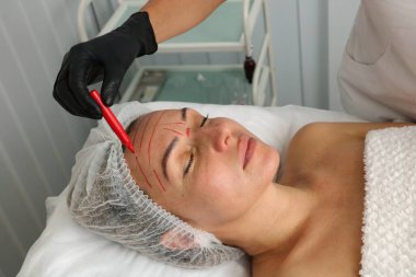 The beautician marks the location of the procedure with a red marker.
