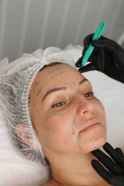 The cosmetologist marks the location of the facial rejuvenation procedure with a green marker on the face of an adult woman. Close-up top view.