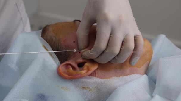 Inyección Anestésica Antes Corrección Elevación Del Hilo Cara Con Hilos — Vídeos de Stock