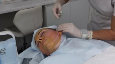 Yetişkin bir kadın için emililebilir ipliklerle yüzün kaldırılması, yakın plan..