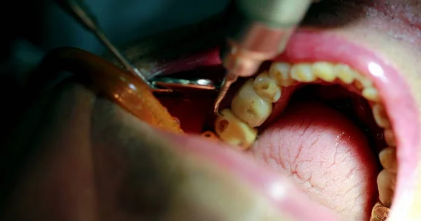 Dental procedure close-up mouth at dentist clinic