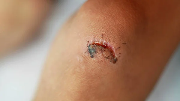 Kid Knee Injury Fall Stitches – stockfoto