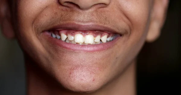 Pré Adolescente Menino Sorrindo Close Criança Boca Dentes — Fotografia de Stock