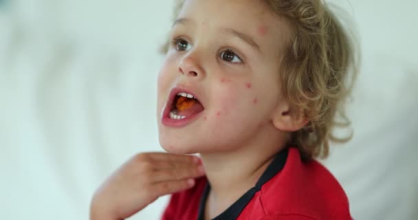 Child Covered Mosquito Bites Chewing Food — Stock Video