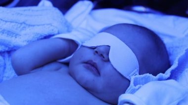 Newborn baby under phototherapy lamp getting treated for jaundice