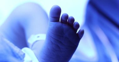 Newborn feed under phototherapy lamp. getting treated for jaundice