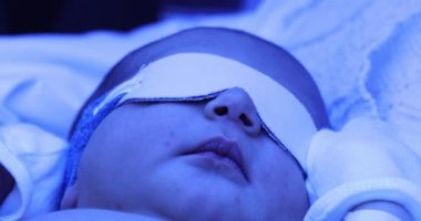 Newborn baby boy getting treated for jaundice under a phototherapy lamp
