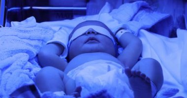 Newborn under jaundice phototherapy treatment