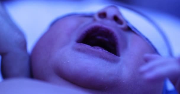 Newborn Jaundice Phototherapy — Stock Video