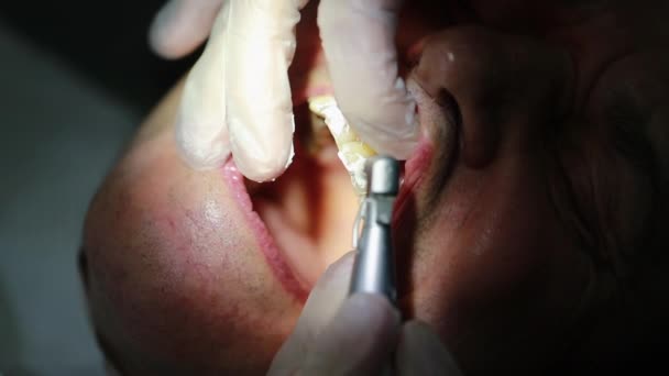Boca Abierta Clínica Dental Procedimiento Odontológico Cerca — Vídeo de stock