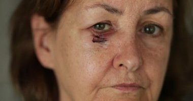 Ameliyat sonrası iyileşme yarası olan yaşlı bir kadın.