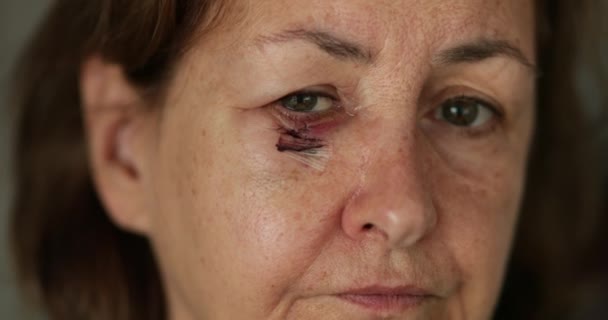 Kameraya Bakan Morarmış Yaralı Yüzlü Yaşlı Kadının Yakın Çekimi — Stok video