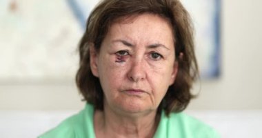 Üzgün görünüşlü, yaralı ve yaralı yüzlü bir kadın. Kameraya bakıyor ve onaylamadığı için başını sallıyor.