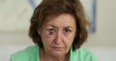 Yüzünde yara izi olan yaşlı bir kadın kameraya bakıyor, üzgün bir duygu.