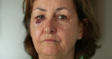 Yaralı suratlı yaşlı kadın kameraya bakıp acı çekiyor.