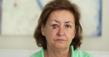 Yüzü morarmış yaşlı bir kadın kameraya bakıyor. Ameliyat sonrası kanser yarası olan yaşlı bir kadın.