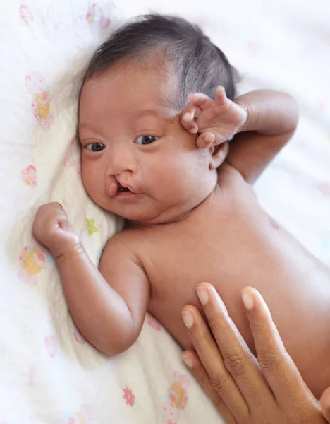 Die liebevolle Berührung einer Mutter. Eine junge Mutter legt ihre Hand auf ihr Baby mit Gaumenspalte. — Stockfoto