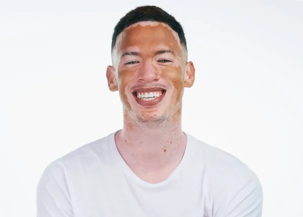 Ce qui te rend différente te rend belle. Portrait d'un beau jeune homme avec du vitiligo posant sur un fond blanc. — Photo