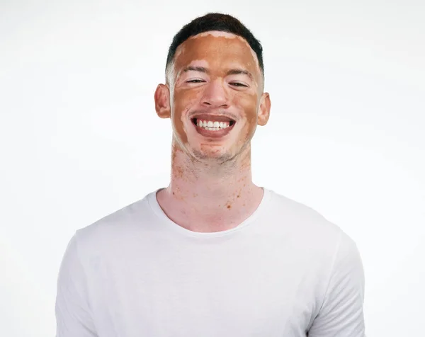 Tengo mis defectos, pero los abrazo y los amo porque son míos. Retrato de un joven guapo con vitiligo posando sobre un fondo blanco. — Foto de Stock