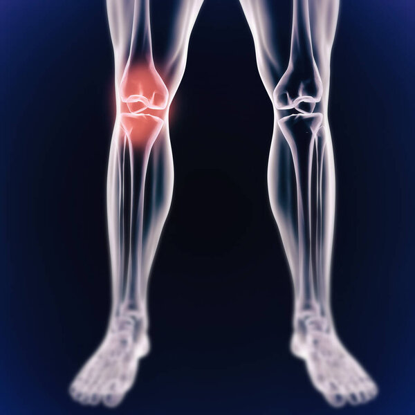 A cgi view of an inflamed joint isolated on blue