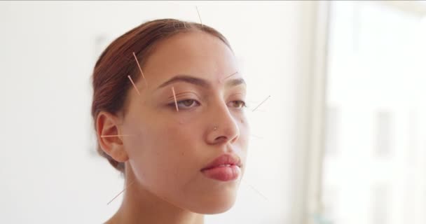 Young Woman Acupuncture Needles Her Head Face Beauty Spa Beautiful — Wideo stockowe