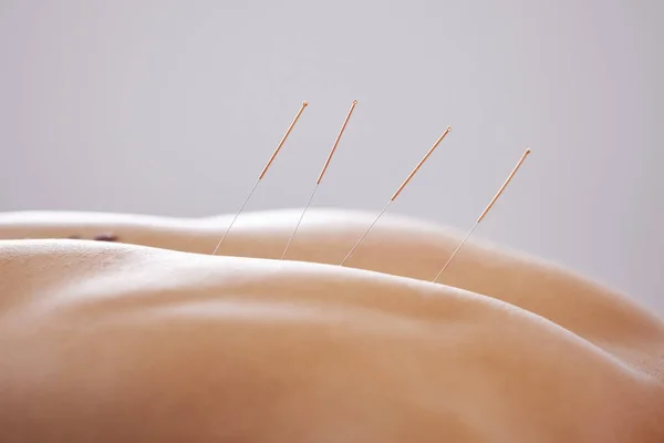 Shouldve Tried Acupuncture Sooner Man Using Acupuncture Needles — Zdjęcie stockowe