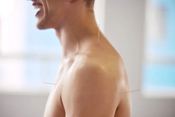 Feel Relieved Man Enjoying Acupuncture Treatment — 图库照片