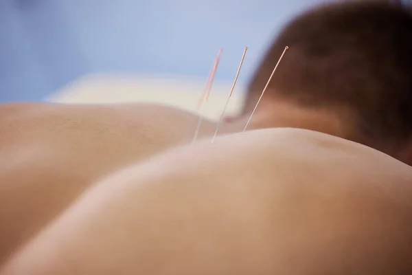 Back Has Been Acting Lately Man Using Acupuncture Needles — 图库照片