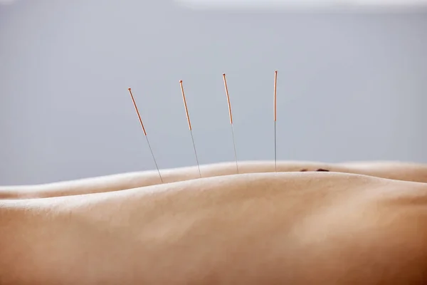 Stick Some Needles Your Body Man Using Acupuncture Needles — Stockfoto