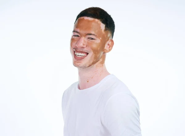 Always Love Spotlight Portrait Shot Handsome Young Man Vitiligo Posing — Stock Photo, Image